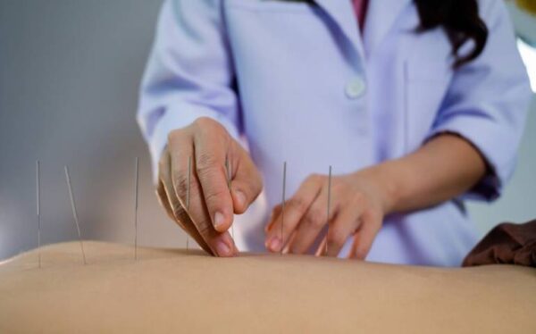 Acupuncture for Pain Relief and Well Being